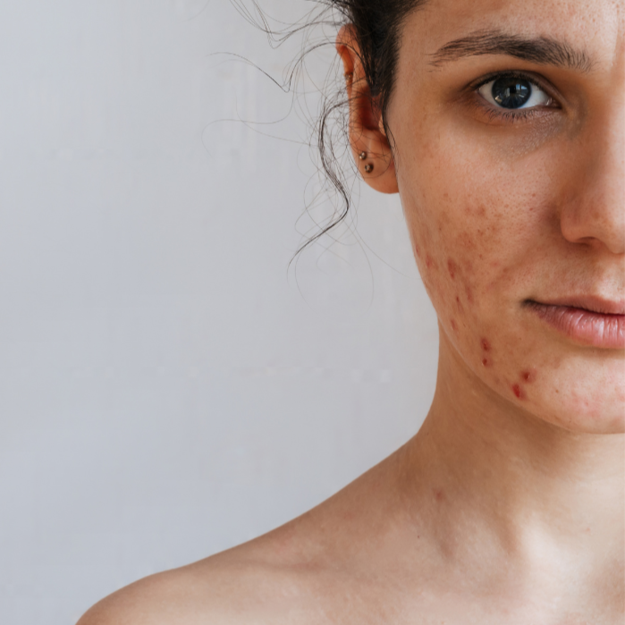 Mind-body Axis - Stressed Skin